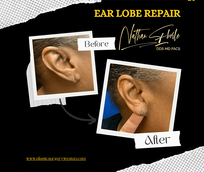Earlobe Repair before and after case 13, actual patient at Weston Center for Plastic Surgery