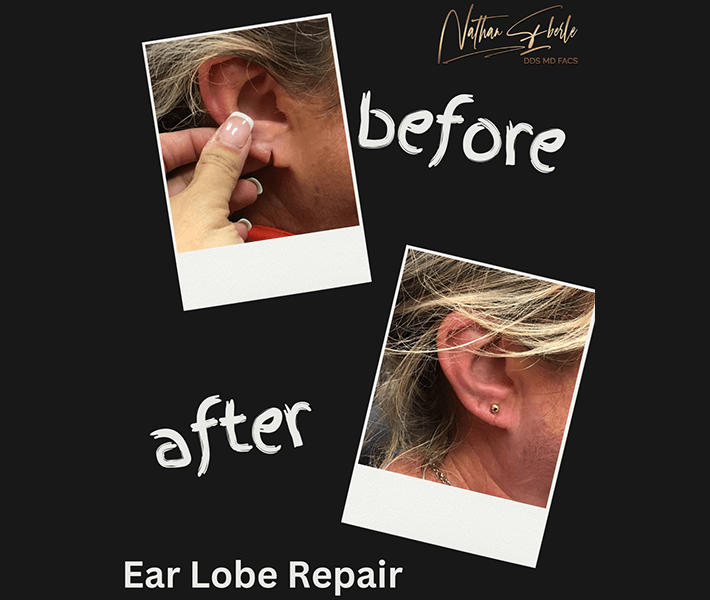 Earlobe Repair before and after case 14, actual patient at Weston Center for Plastic Surgery