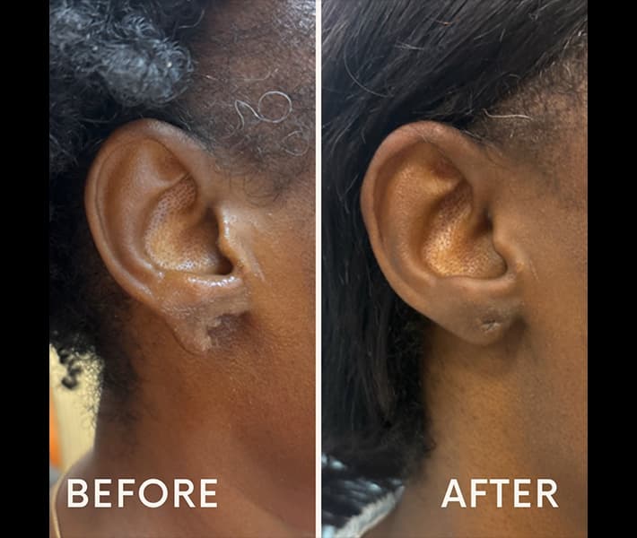 Earlobe Repair before and after case 15, actual patient at Weston Center for Plastic Surgery