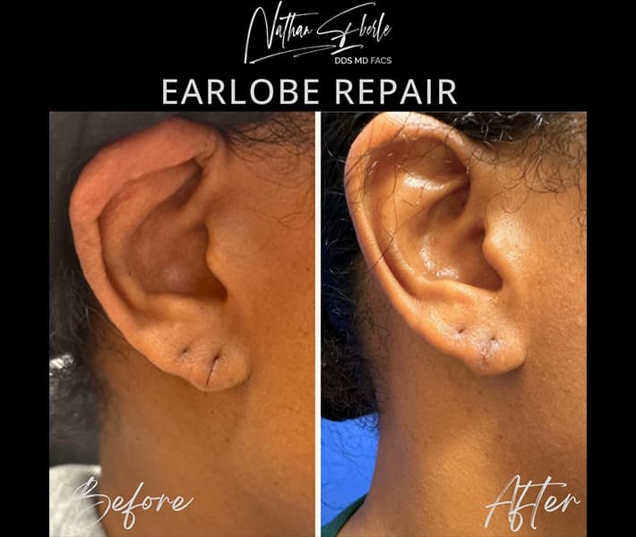 Earlobe Repair before and after case 16, actual patient at Weston Center for Plastic Surgery