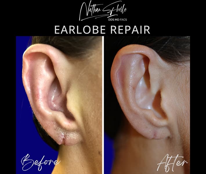 Earlobe Repair before and after case 17, actual patient at Weston Center for Plastic Surgery