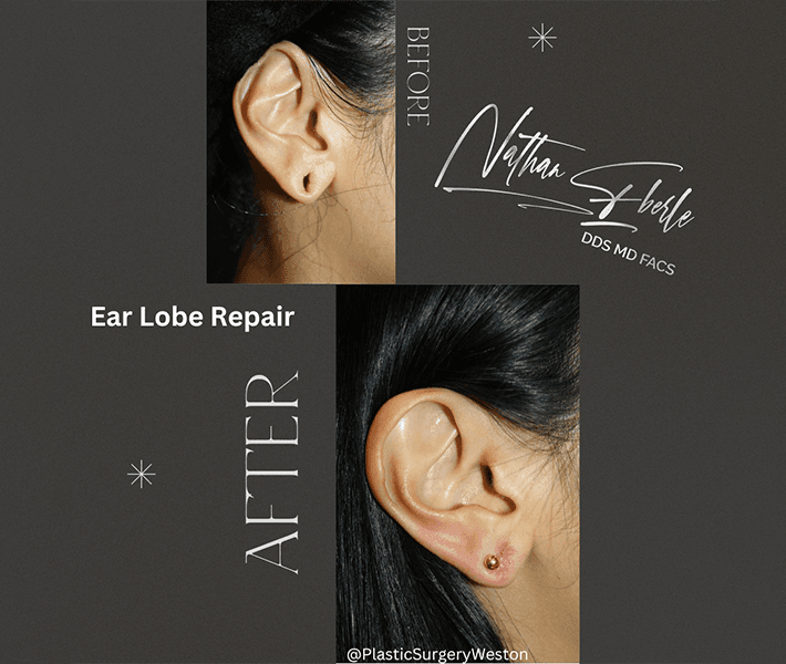 Earlobe Repair before and after case 2, actual patient at Weston Center for Plastic Surgery