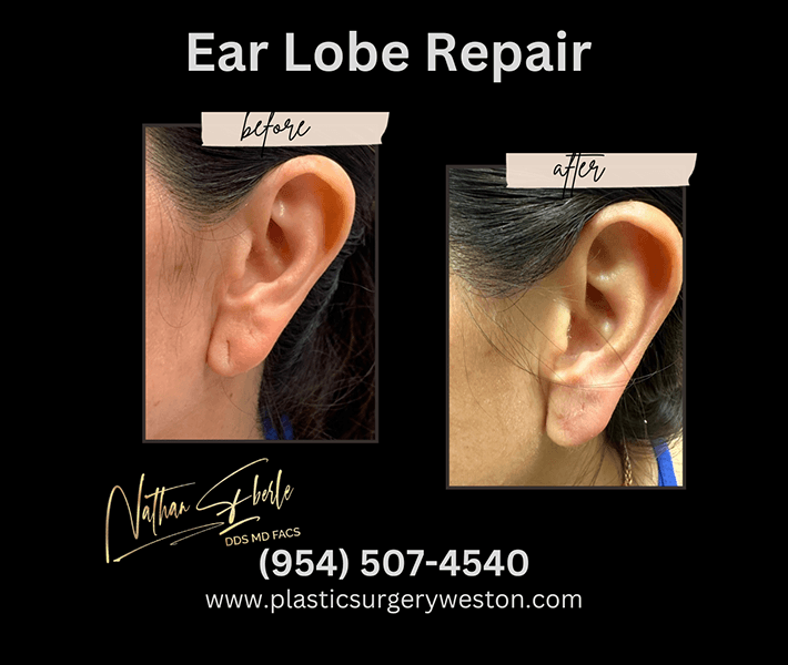 Earlobe Repair before and after case 3, actual patient at Weston Center for Plastic Surgery