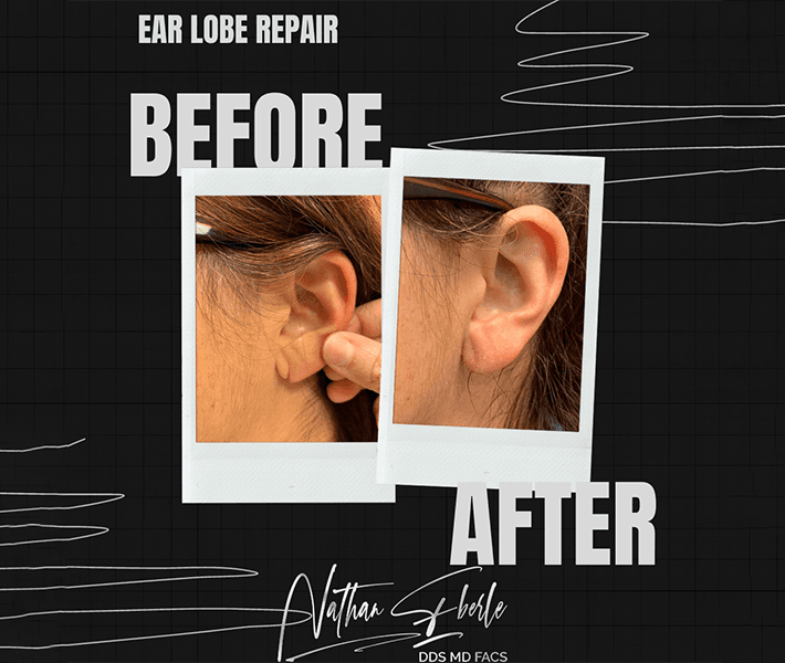 Earlobe Repair before and after case 4, actual patient at Weston Center for Plastic Surgery