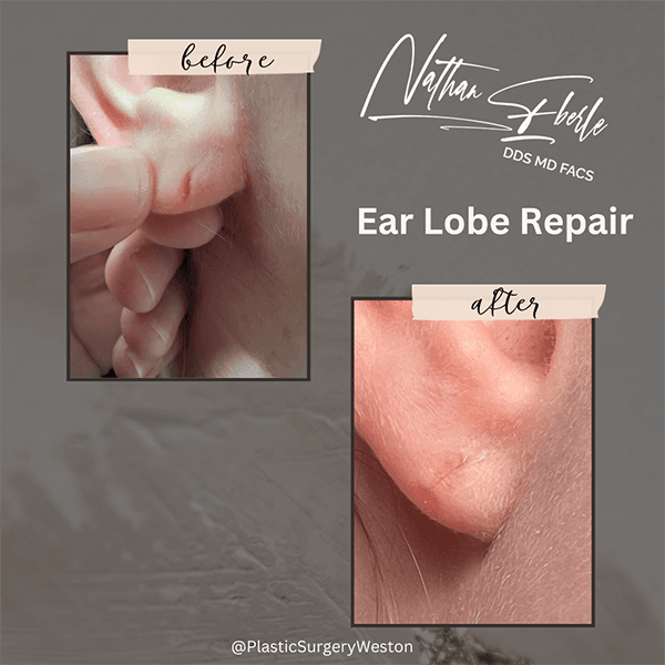 Earlobe Repair before and after case 5, actual patient at Weston Center for Plastic Surgery