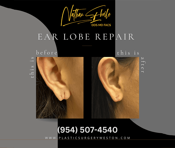 Earlobe Repair before and after case 6, actual patient at Weston Center for Plastic Surgery