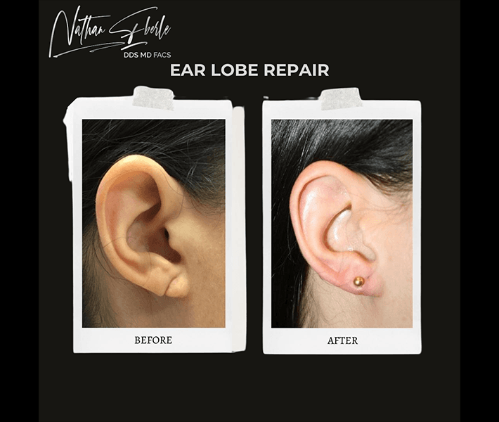 Earlobe Repair before and after case 7, actual patient at Weston Center for Plastic Surgery