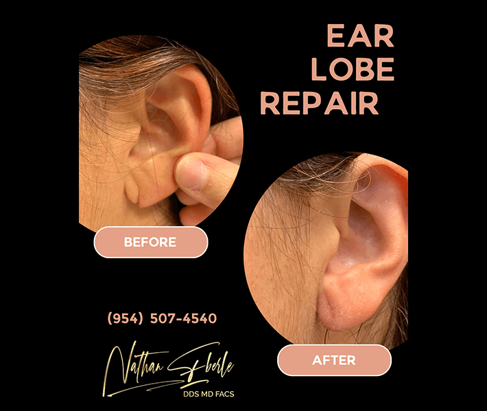 Earlobe Repair before and after case 8, actual patient at Weston Center for Plastic Surgery