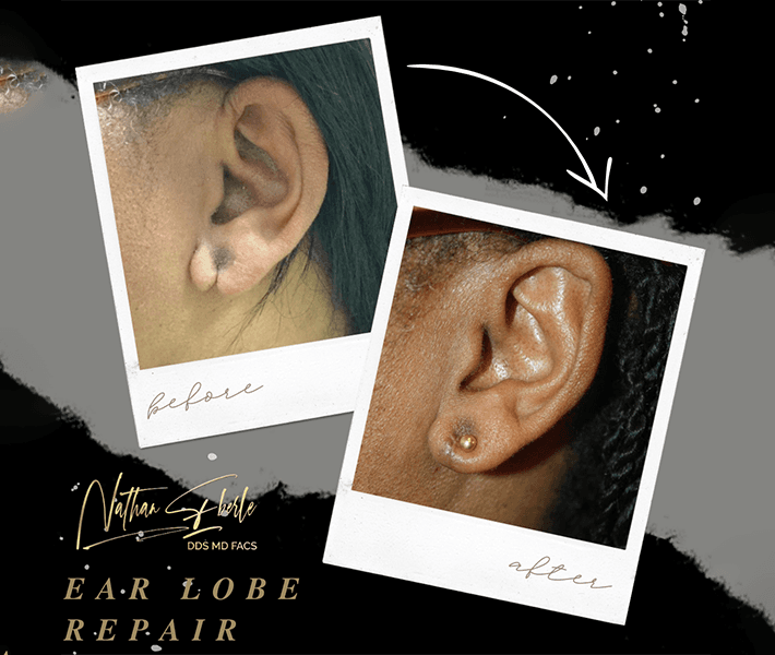 Earlobe Repair before and after case 9, actual patient at Weston Center for Plastic Surgery