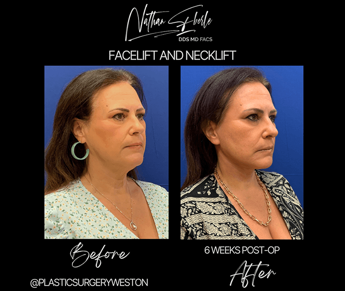 Facelift before and after case 1, actual patient at Weston Center for Plastic Surgery