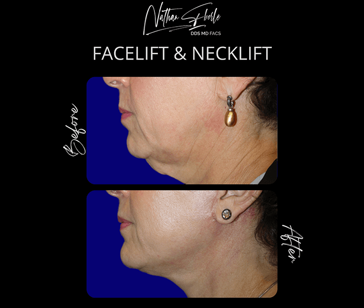 Facelift before and after case 13, actual patient at Weston Center for Plastic Surgery