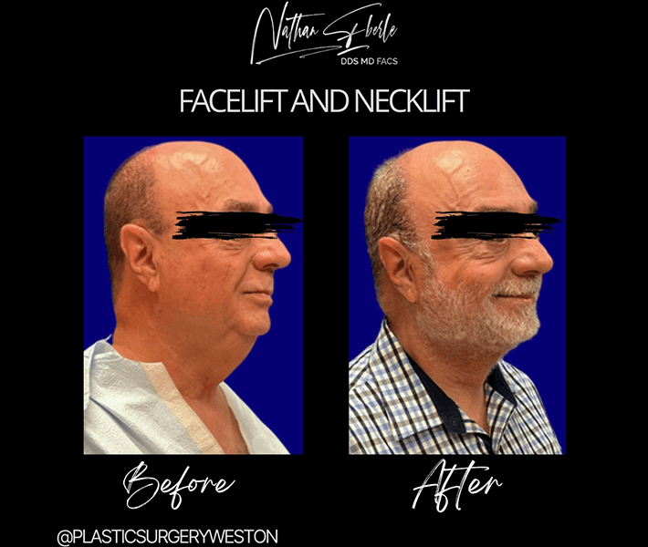 Facelift before and after case 15, actual patient at Weston Center for Plastic Surgery