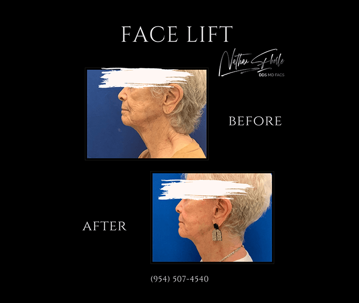 Facelift before and after case 17, actual patient at Weston Center for Plastic Surgery