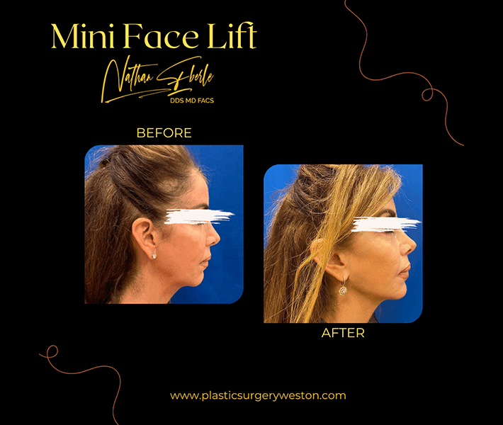 Facelift before and after case 18, actual patient at Weston Center for Plastic Surgery