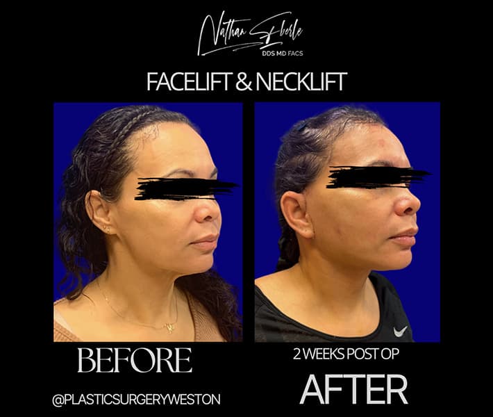 Facelift before and after case 19, actual patient at Weston Center for Plastic Surgery