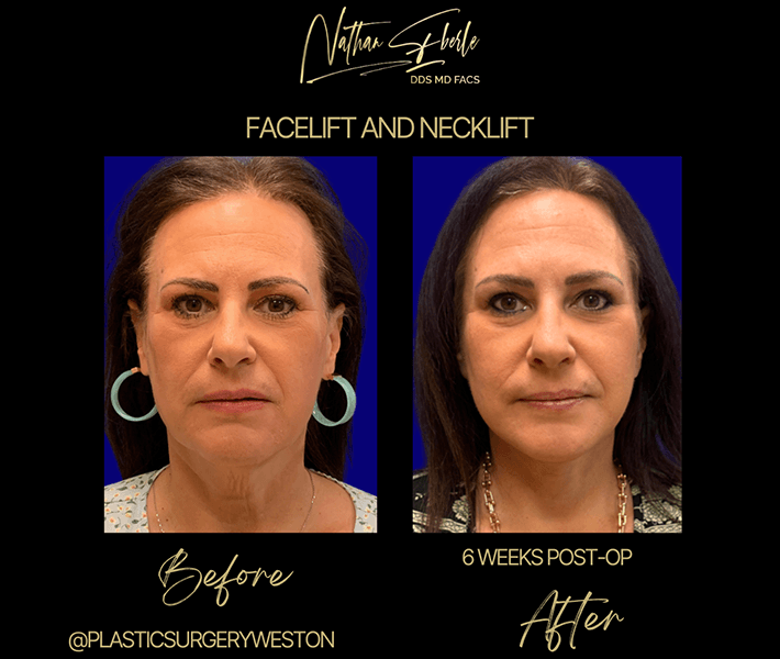 Facelift before and after case 2, actual patient at Weston Center for Plastic Surgery
