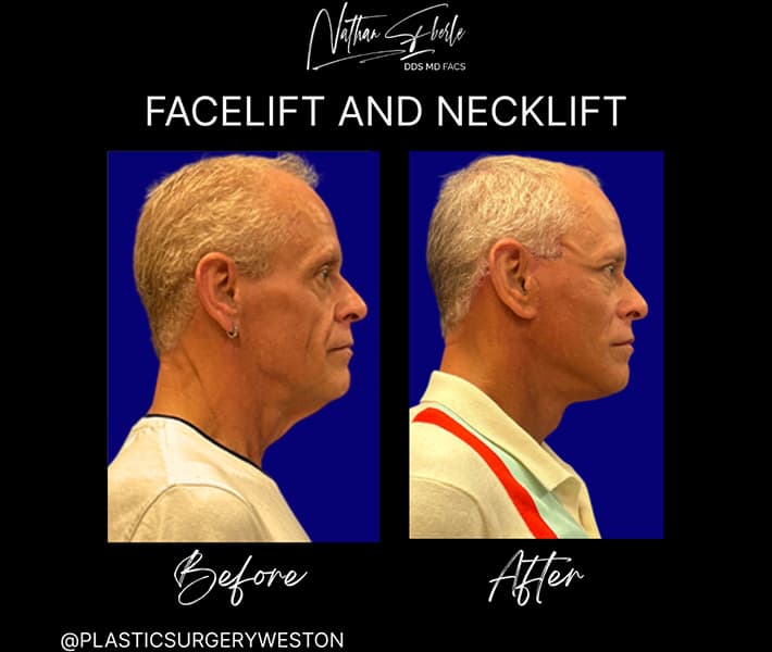 Facelift before and after case 20, actual patient at Weston Center for Plastic Surgery