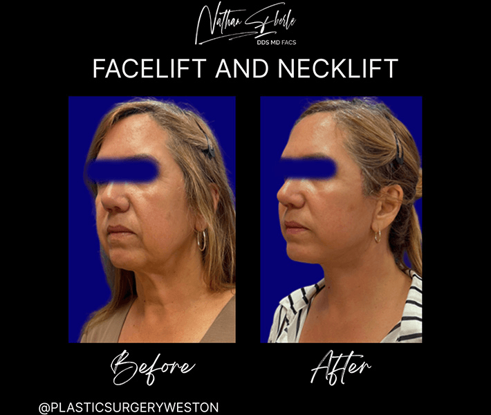 Facelift case 21 before and after results at Weston Center for Plastic Surgery