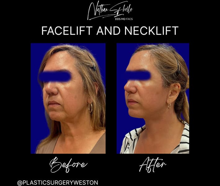 Facelift before and after case 22, actual patient at Weston Center for Plastic Surgery