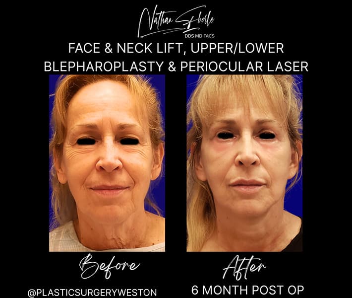 Facelift before and after case 23, actual patient at Weston Center for Plastic Surgery
