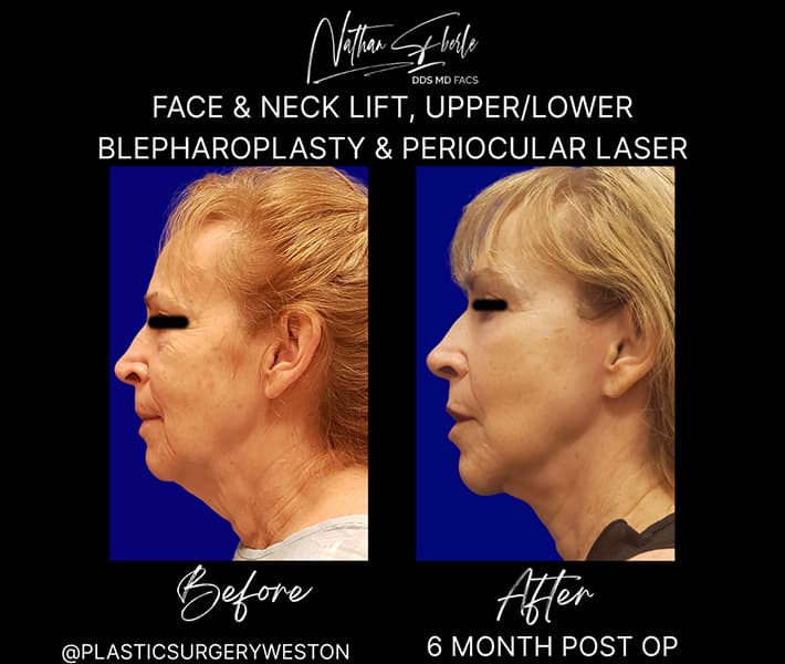 Facelift before and after case 24, actual patient at Weston Center for Plastic Surgery
