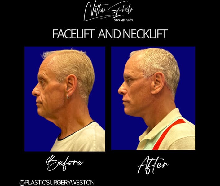 Facelift before and after case 25, actual patient at Weston Center for Plastic Surgery