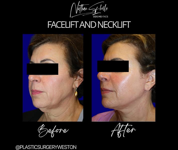 Facelift before and after case 27, actual patient at Weston Center for Plastic Surgery