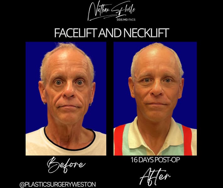 Facelift before and after case 28, actual patient at Weston Center for Plastic Surgery