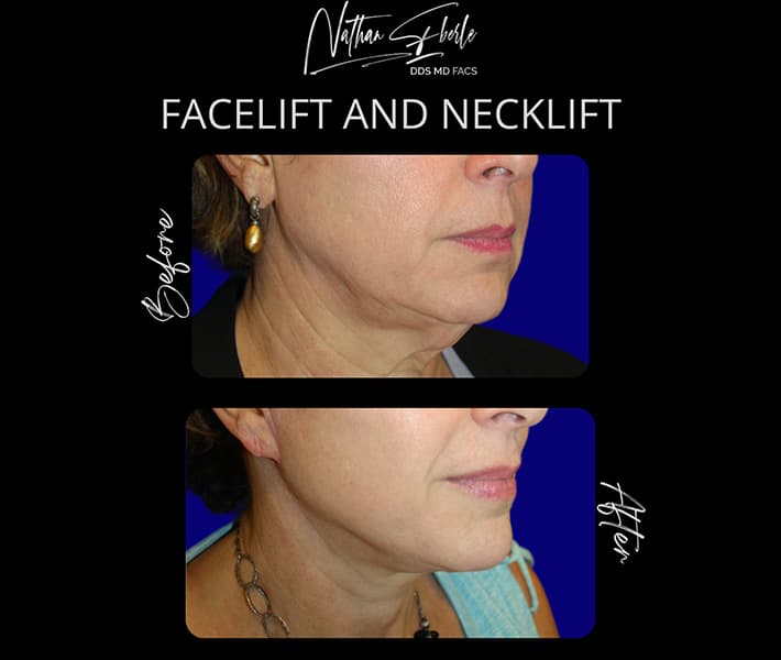 Facelift before and after case 29, actual patient at Weston Center for Plastic Surgery