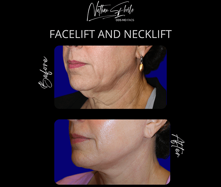 Facelift before and after case 3, actual patient at Weston Center for Plastic Surgery