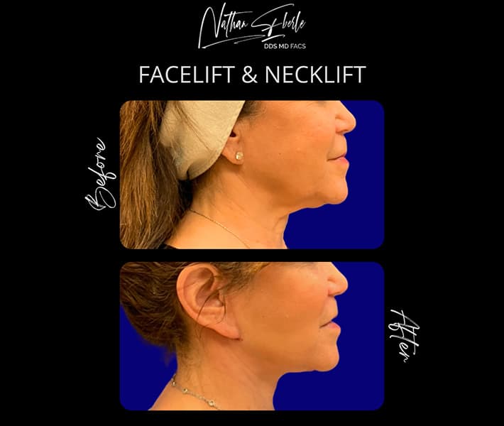 Facelift before and after case 30, actual patient at Weston Center for Plastic Surgery
