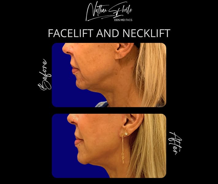 Facelift before and after case 31, actual patient at Weston Center for Plastic Surgery