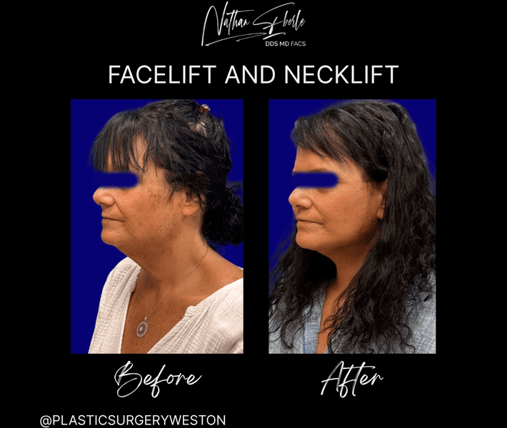 Facelift case 32 before and after results at Weston Center for Plastic Surgery