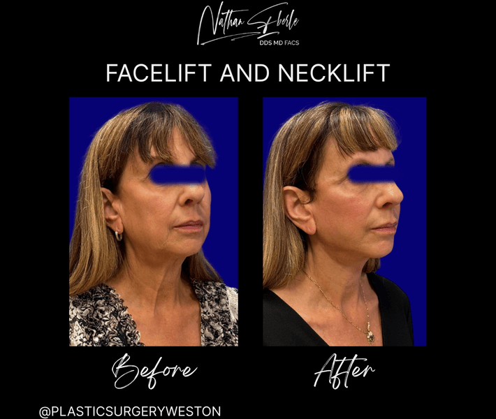 Facelift case 33 before and after results at Weston Center for Plastic Surgery