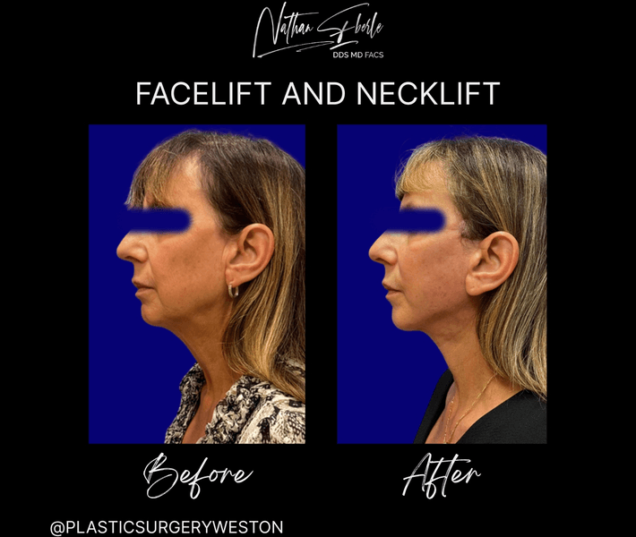 Facelift case 34 before and after results at Weston Center for Plastic Surgery