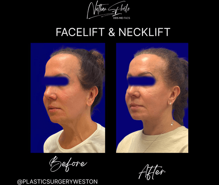 Facelift case 35 before and after results at Weston Center for Plastic Surgery
