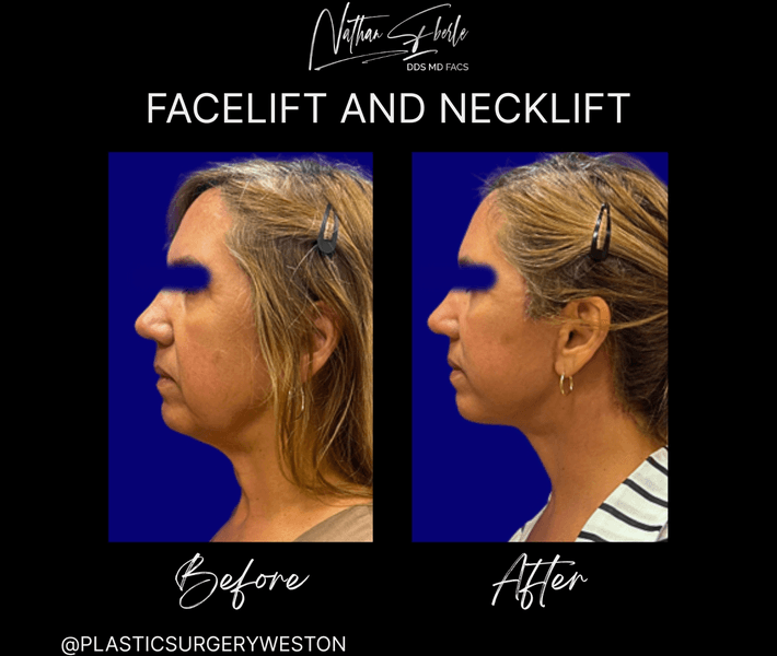 Facelift case 36 before and after results at Weston Center for Plastic Surgery
