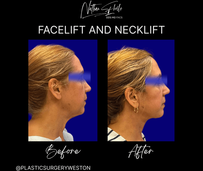 Facelift case 37 before and after results at Weston Center for Plastic Surgery
