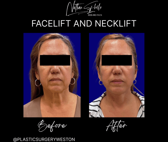 Facelift case 38 before and after results at Weston Center for Plastic Surgery