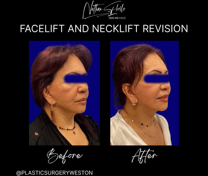 Facelift case 39 before and after results at Weston Center for Plastic Surgery