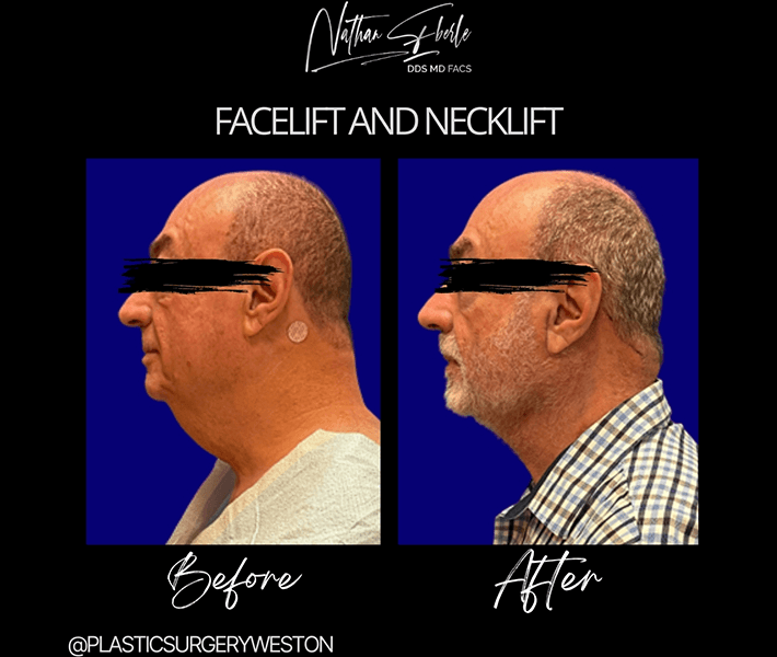 Facelift before and after case 4, actual patient at Weston Center for Plastic Surgery