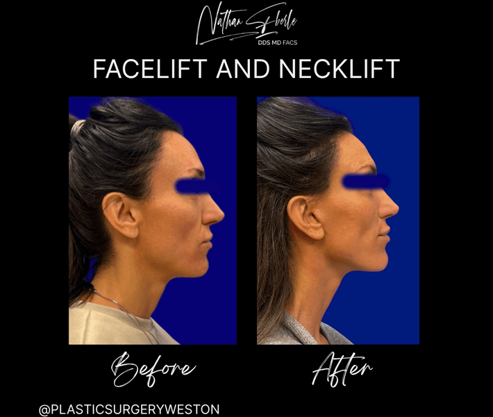 Facelift case 40 before and after results at Weston Center for Plastic Surgery
