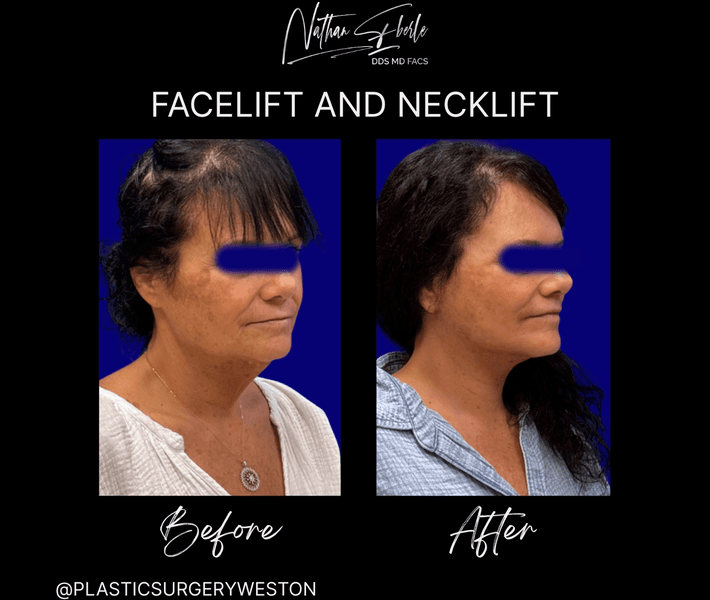 Facelift case 41 before and after results at Weston Center for Plastic Surgery