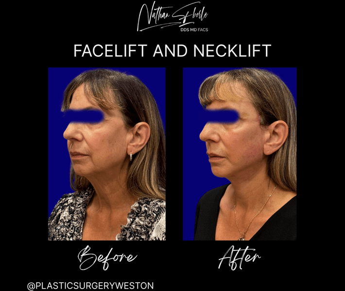 Facelift case 42 before and after results at Weston Center for Plastic Surgery