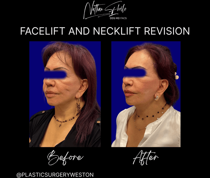 Facelift case 43 before and after results at Weston Center for Plastic Surgery