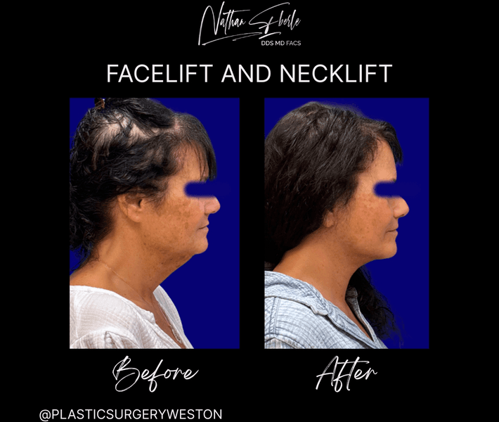 Facelift case 44 before and after results at Weston Center for Plastic Surgery
