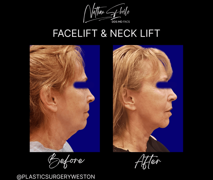 Facelift case 45 before and after results at Weston Center for Plastic Surgery