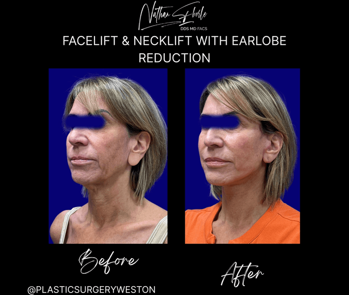 Facelift case 46 before and after results at Weston Center for Plastic Surgery
