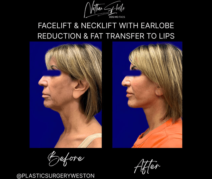 Facelift case 47 before and after results at Weston Center for Plastic Surgery