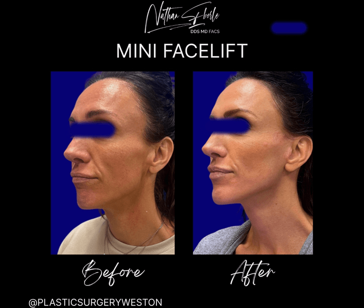 Facelift case 48 before and after results at Weston Center for Plastic Surgery